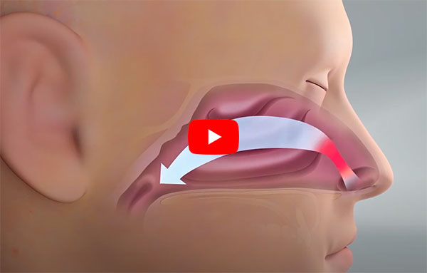 Latera Absorbable Nasal Implant