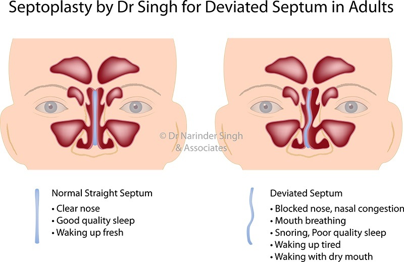 deviated septum surgery bruising
